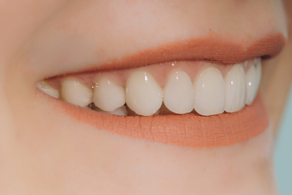 Zahnästhetik Frontzähne mit Veneers und Keramikkronen