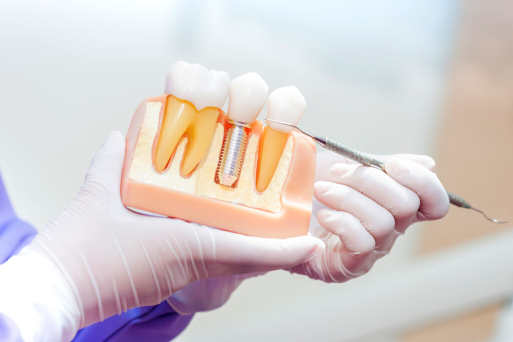 Implantat, Modell, Beratung zur Behandlung